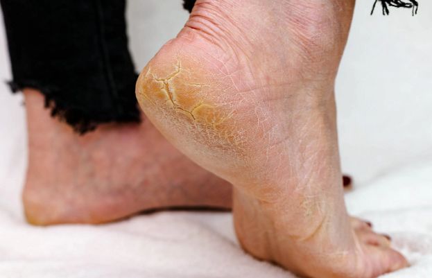 How to Get Rid of Dry Skin on Your Feet