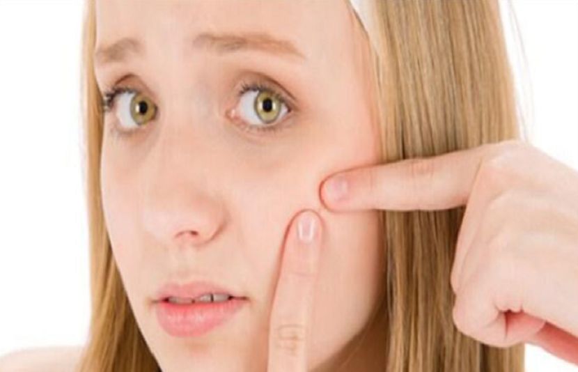 چہرے کے کیل مہاسے دور کرنے کی تدابیر