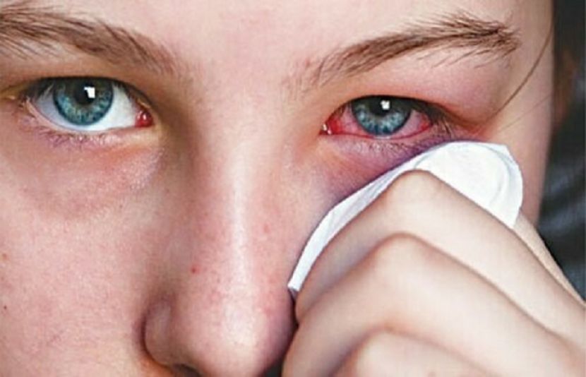 آنکھوں کی بیماری