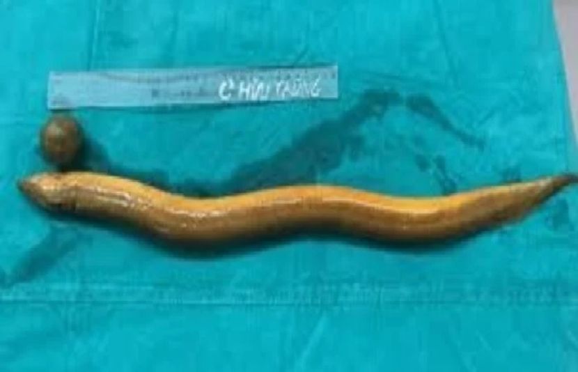 ویتنام کے ڈاکٹرز نے ہنگامی سرجری کر کے ایک بھارتی نوجوان کے پیٹ سے مچھلی نکال لی ہے