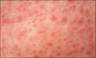 خسرہ میں مبتلا