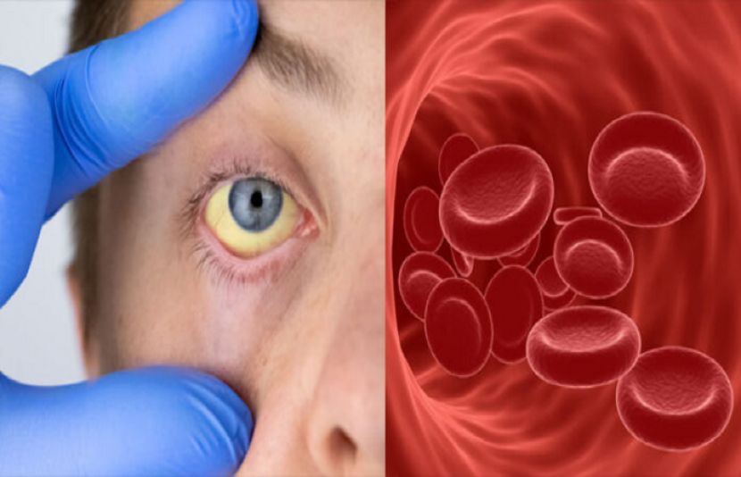 &quot;انیمیا&quot; کی عام علامات