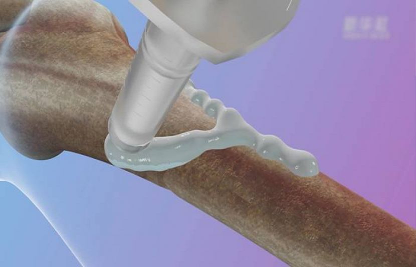 ہڈی کو اسٹیل کی طرح جوڑنے والا نیا گلو محققین نے ایجاد کر لیا