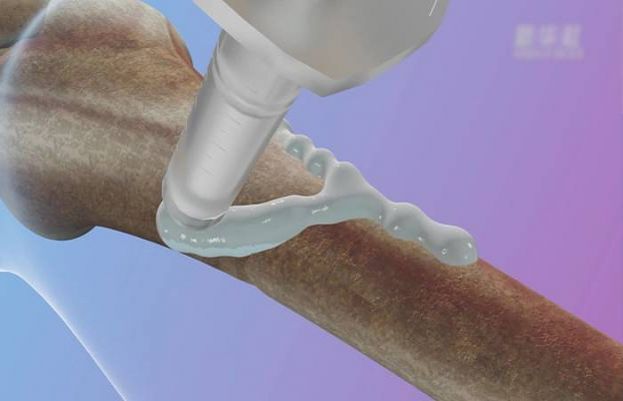 ہڈی کو اسٹیل کی طرح جوڑنے والا نیا گلو محققین نے ایجاد کر لیا