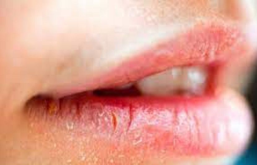 سردیوں میں پھٹے ہونٹوں کو خوشنما کیسے بنائیں؟