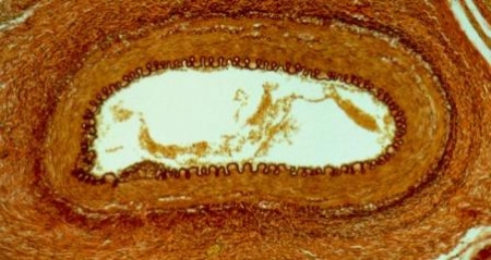 شریانوں میں سوزش کی بیماری