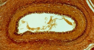 شریانوں میں سوزش کی بیماری