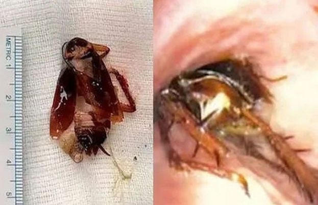 ایک شخص کے گلے میں تقریباً 3 دن تک لال بیگ پھنسا رہا اور شہری کو پتہ ہی نہیں چل سکا