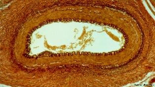 شریانوں میں سوزش کی بیماری میں اضافہ