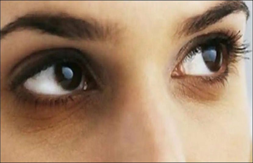 آنکھوں کے گرد سیاہ حلقے کم کرنے کے نہایت آسان طریقے
