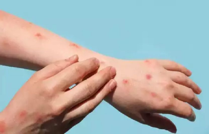 ملک میں ایم پاکس کا پہلا کیس سامنے آگیا