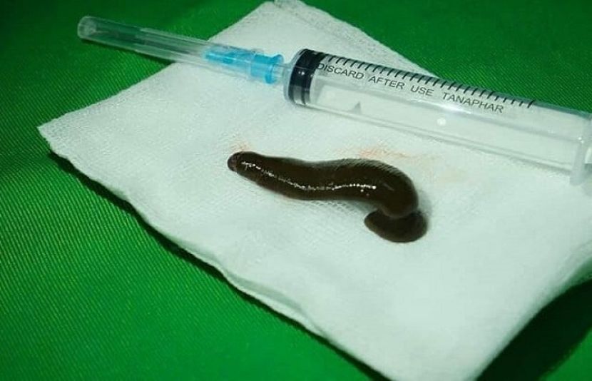 ویتنام میں ایک شہری کو اس وقت اپنی زندگی کا سب سے بڑا دھچکا لگا جب اسے پتہ چلا کے اس کے گلے میں ایک جونک چپکی ہوئی ہے