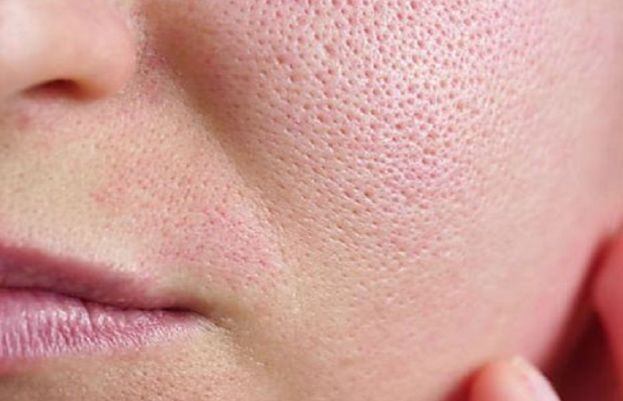 چہرے کے کھلے مسام کیسے بند کریں؟ جانیے آسان طریقے