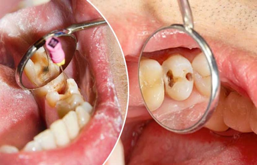 دانتوں کے کیڑوں کا آسان گھریلو علاج۔