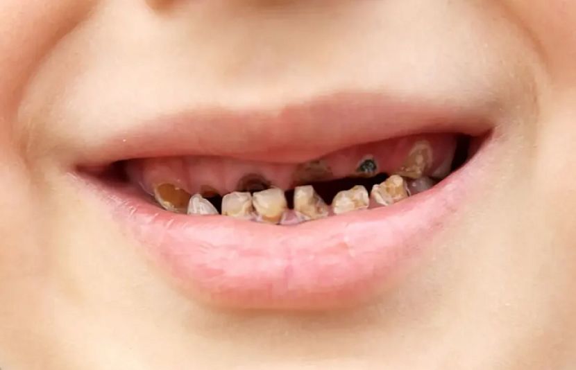 دانتوں میں کیڑا کیوں لگتا ہے؟ جانیئے اس کی وجوہات اور آسان گھریلو علاج