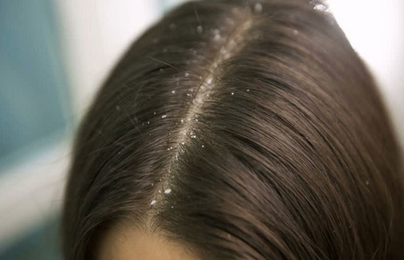 بالوں میں خشکی سے کیسے نمٹا جائے؟