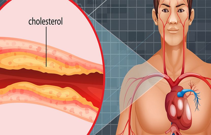 کولیسٹرول دماغی بیماریوں کا باعث ہے